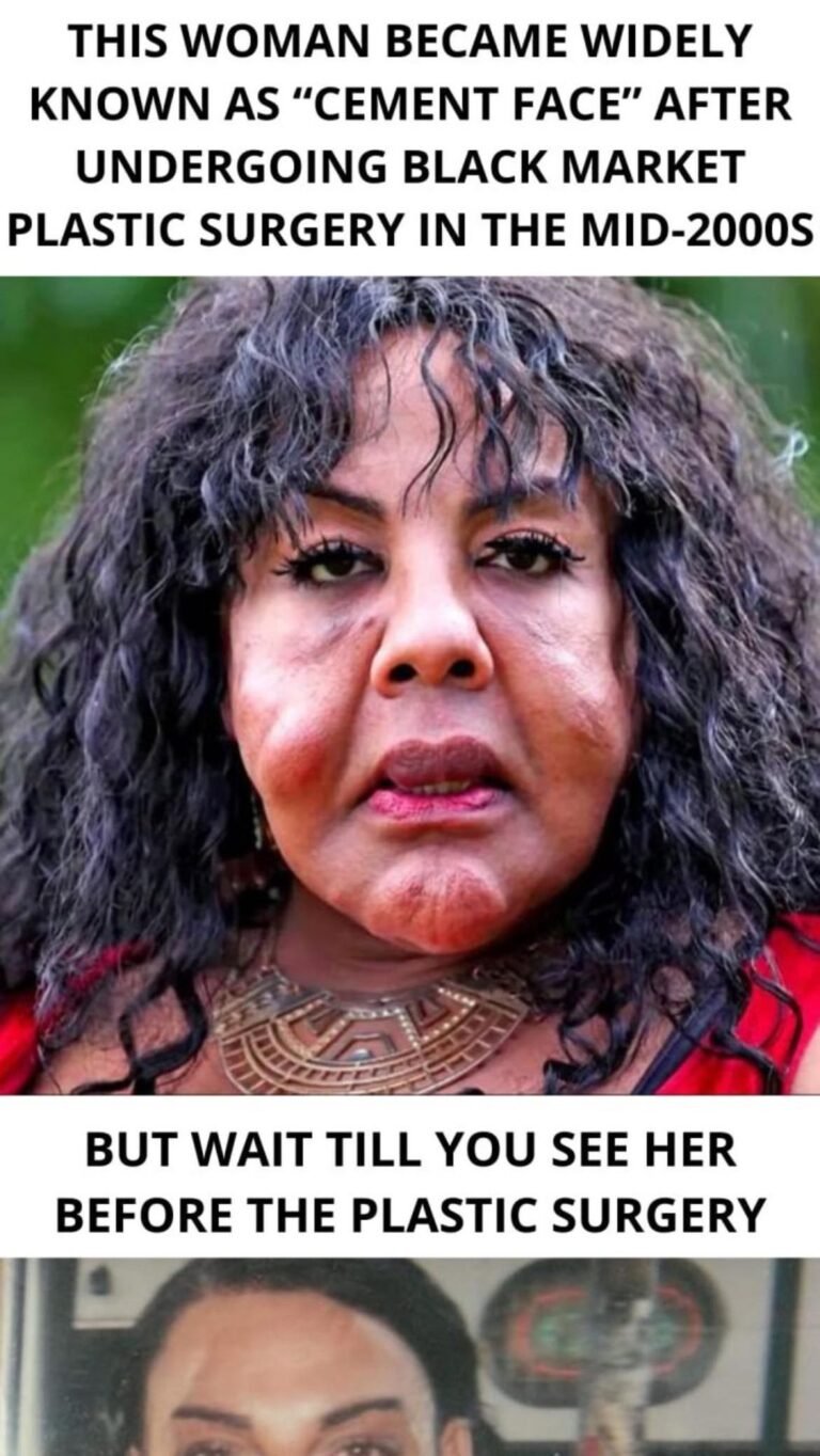 “She Was Injected With Cement — See Her Shocking Transformation 14